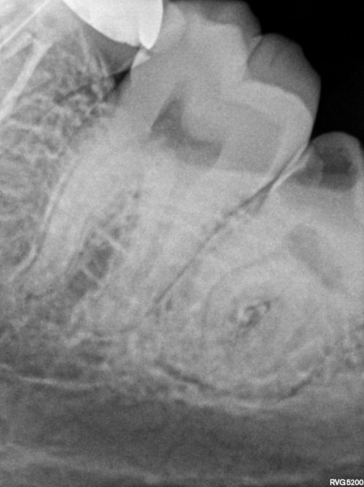 Dental X-ray